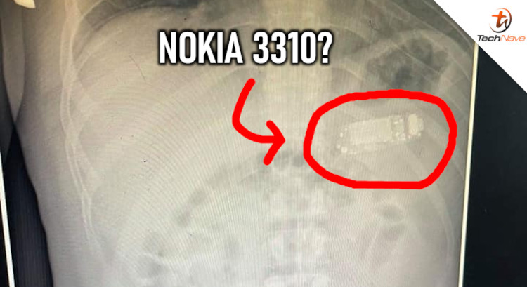 Doctors extracted a Nokia 3310 from a man's stomach after he managed to swallow the whole thing