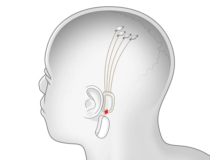 neuralink_embeddedchipconcept.jpg