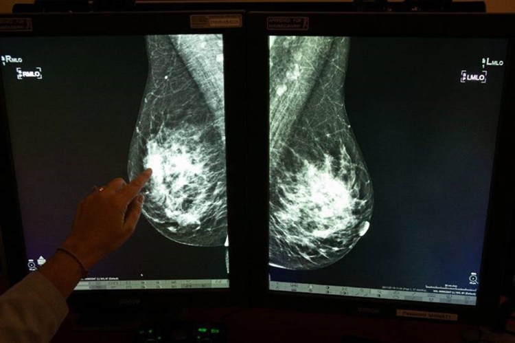 qview breast cancer ai